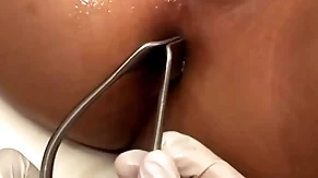 Asian patient penetrated in anal crevice away from scantling in missionary